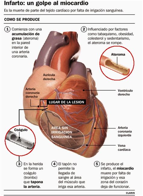 SALUD CARDIOVASCULAR Síntomas comunes de las enfermedades cardiovasculares