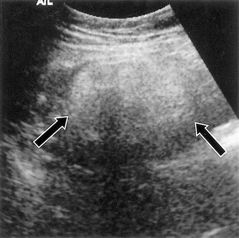 Ovarian Teratomas Tumor Types And Imaging Characteristics Radiographics