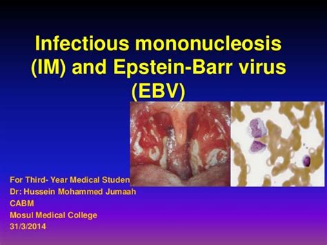 Infectious mononucleosis (im) and epstein barr virus