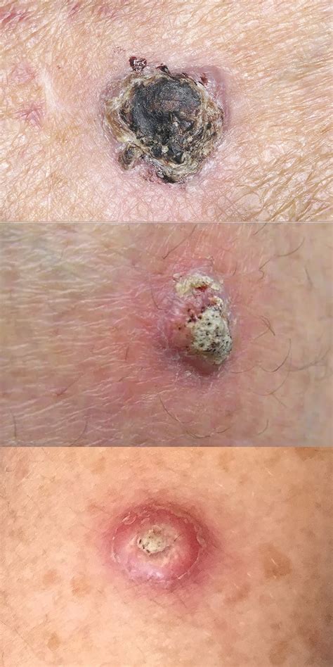 What Does A Squamous Cell Skin Cancer Look Like Cancerwalls The Best