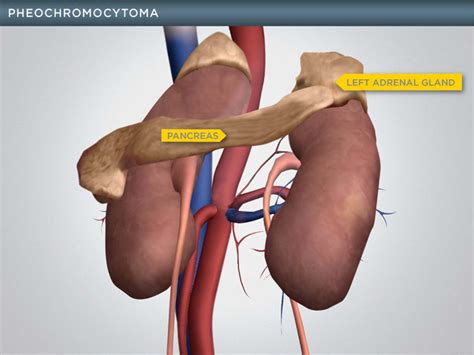 Illustration of Pheochromocytoma - Visual Advantage | Courtroom ...