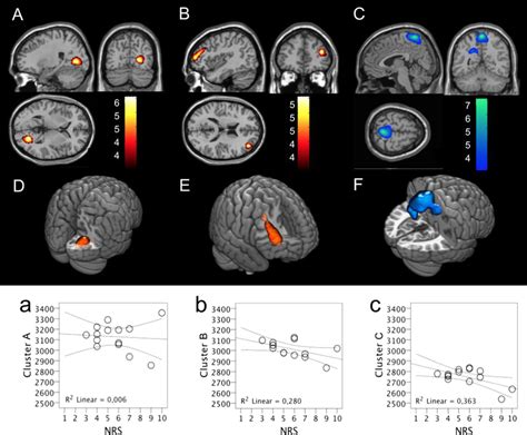 Results Of The Statistical Parametric Mapping SPM Analysis Showing