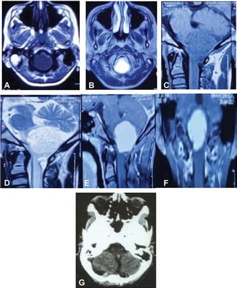 MRI posterior fossa T1W axial image showing a well-circumscribed ...