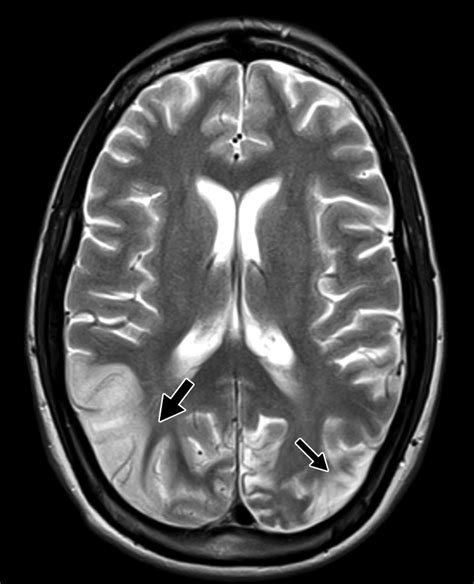 Cerebral Edema Ajr