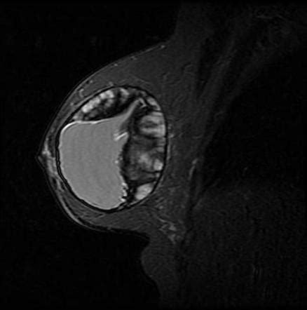 Breast Implant Rupture Image Radiopaedia Org