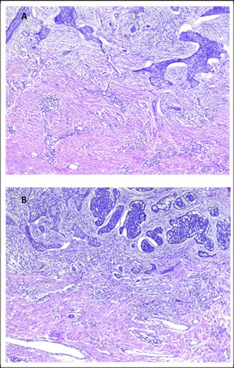 Histopathological Examination A B Basaloid Tumor Cells In Nests