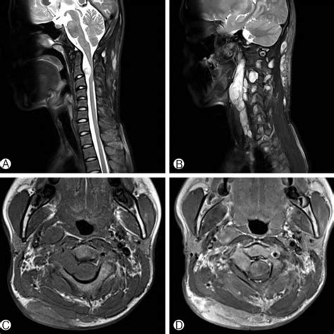 Preoperative Mri Of Cervical Spine T1 A And T2 Weighted B Sagittal