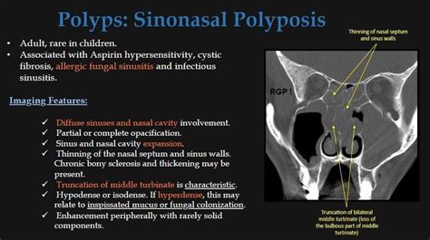 Nasal Polyps Anatomy