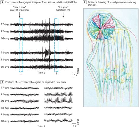 Visual Phenomena In Occipital Lobe Epilepsy “it’s Beautiful ” Epilepsy And Seizures Jama