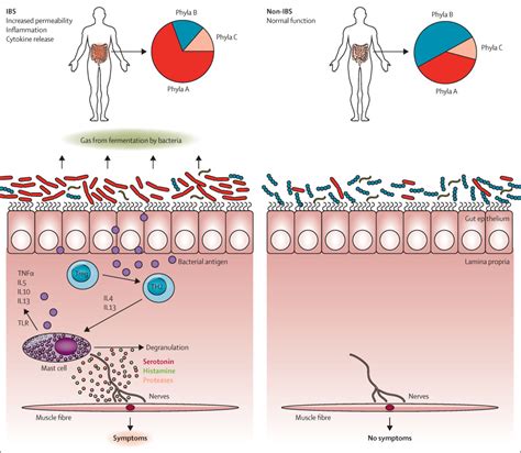 Irritable Bowel Syndrome Diagram