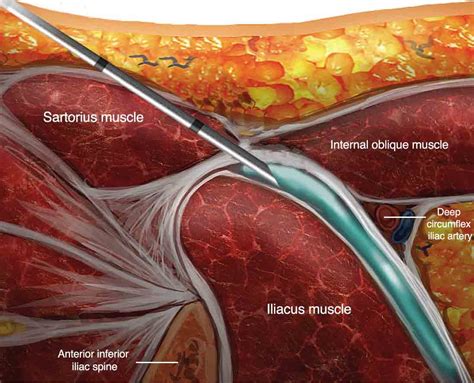 Ilioinguinal Nerve Block Ultrasound