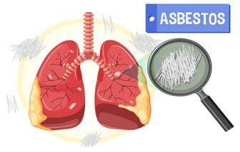 Asbestosis Symptoms - Everything You Need To Know - TOTAL