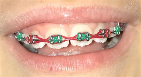 Good Braces Color Combos Warehouse Of Ideas