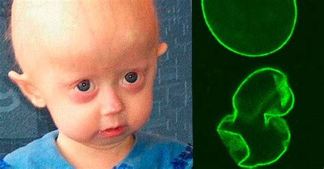 Progeria Implicaciones Sociales Y Medicas