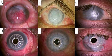 Results Of Lucia Keratoprosthesis Implantation In Severe Corneal