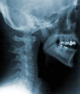 Atlantoaxial Joint Subluxation