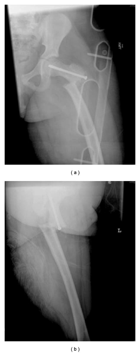 Ap A And Lateral B Radiographic Views Of The Left Hip And Thigh