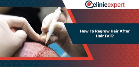 How To Regrow Hair After Hair Fall Clinicexpert