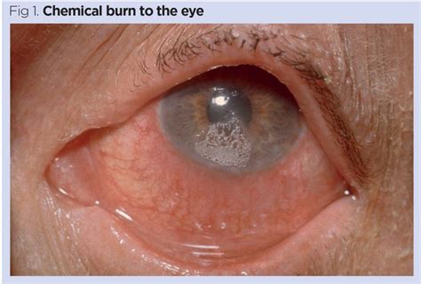 Procedure For Eye Irrigation To Treat Ocular Chemical Injury Nursing