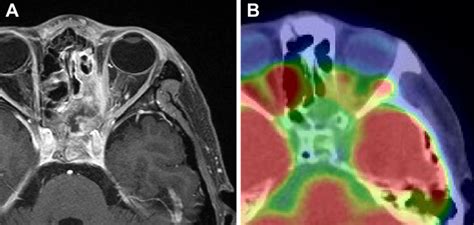 Figure6.Magnetic resonance imaging (MRI) (A) and positron emission ... 