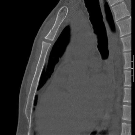 Axial CT of the sternum, showing a lytic bone lesion fracture ...