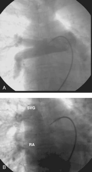 Partial Anomalous Pulmonary Venous Return | Thoracic Key