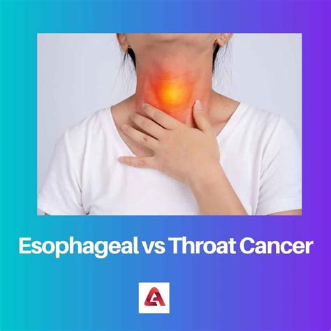 Esophageal Vs Throat Cancer Difference And Comparison