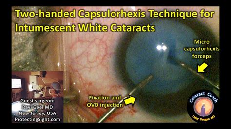 Two Handed Capsulorhexis Technique For Intumescent White Cataracts Youtube