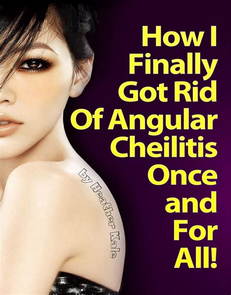 How I Finally Got Rid Of Angular Cheilitis Once And For All Cracked