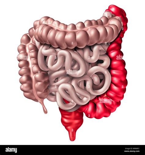 Inflammatory Bowel Disease Hi Res Stock Photography And Images Alamy