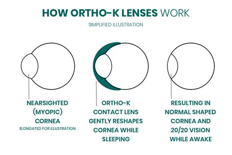 Ortho-K Contact Lenses in Oklahoma | BeSpoke Vision