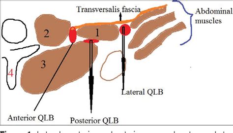 Figure From Bilateral Quadratus Lumborum Block For Post Caesarean