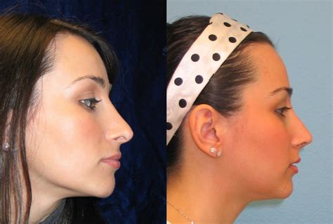 Nose Surgery Before And After Photos Patient 48 San Francisco Ca Kaiser Permanente Cosmetic