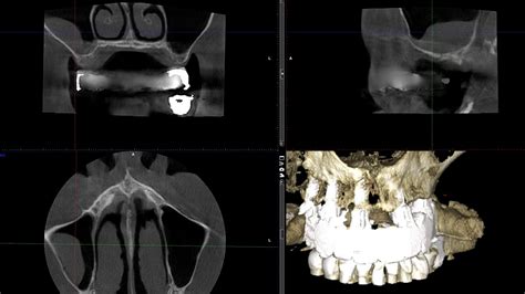 Mucous Retention Pseudocyst In Cbct YouTube