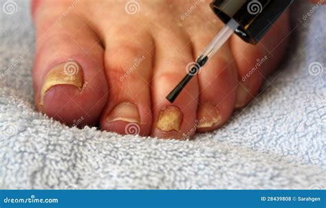 Toenail Fungus Treatment Royalty Free Stock Photos - Image: 28439808