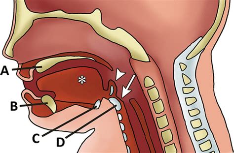 Imaging Acute Airway Obstruction In Infants And Children Radiographics