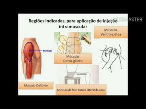 T Cnica De Aplica O De Inje O Intramuscular Im Delt Ide Gl Teo