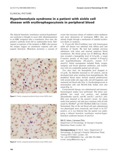 Pdf Hyperhemolysis Syndrome In A Patient With Sickle Cell Disease