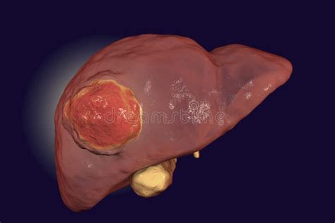 Liver Cancer Illustration Stock Illustration Illustration Of Medical 95090767