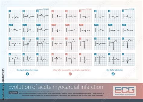 Male Years Old Was Clinically Diagnosed With Acute Anterior