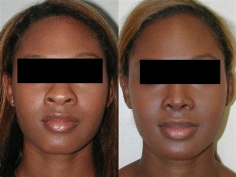 Chirurgie Esth Tique Nez Africain Paris Guide Complet Et Tarifs