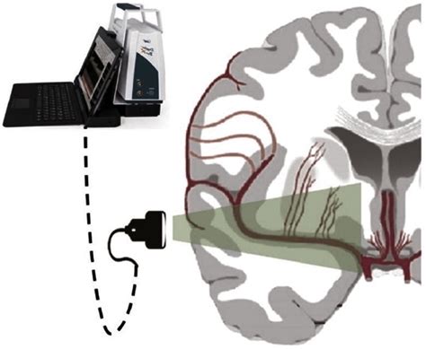 Early Use Of Transcranial Doppler Ultrasonography To Stratify Neonatal