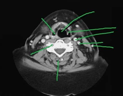 Head And Neck Slice Diagram Quizlet
