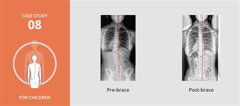 Pediatric Scoliosis Treatment - Scoliosis Centers of Boston MA and Jacksonville FL