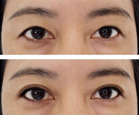 The Ultimate Guide to Natural Looking Double Eyelid Surgery Singapore ...