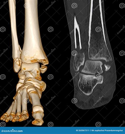 Ct Scan Foot Axial Hot Sex Picture