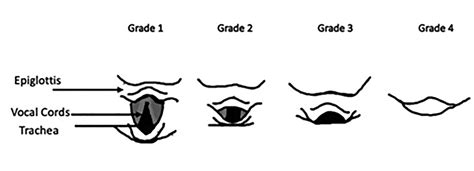 Managing The Difficult Airway In The Emergency Relias Media