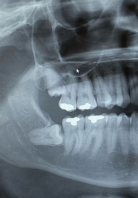 My Tooth Is Growing Sideways Rmildlyinteresting