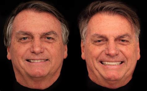 Bolsonaro fez harmonização facial