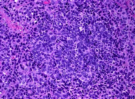 Pathology Outlines Small Cell Neuroendocrine Carcinoma